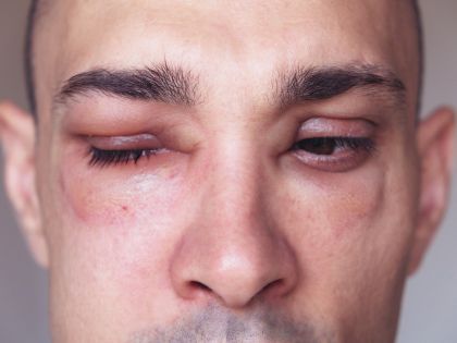 Průlom v léčbě náhlých otoků: ne vždy se jedná o alergie, skutečnost může být daleko nebezpečnější
