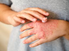 Ekzém může souviset s vaší negativitou, tvrdí psychodermatologie
