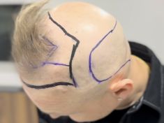 Mužům, kteří bojují s plešatěním, nabízí řešení transplantace vlasů. Bohužel ale není pro všechny