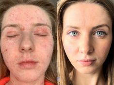 Nikol Macháčková: Dermatologové předepisují kortikosteroidy jako bonbony