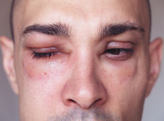 Průlom v léčbě náhlých otoků: ne vždy se jedná o alergie, skutečnost může být daleko nebezpečnější