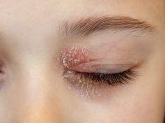 Když stres mluví přes kůži: Potlačené emoce vám mohou vylézt na obličej. Doslova