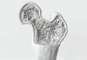 Křehké kosti ke stáří patřit nemusí. Na mléko ale zapomeňte