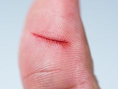 Z malé ranky do márnice. Jak se z nevinného poranění stává boj o život