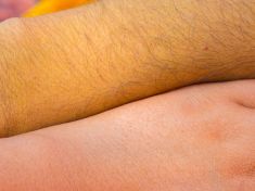 Zítra vám zavolá hygiena. Praha zažívá se žloutenkou déjà vu