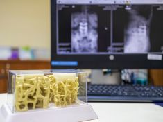 Osteoporóza bolí až pozdě. Tohle jsou mýty, které ji tiše zhoršují