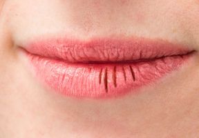 Ozempicový úsměv. Sucho, zápach a problémy, které zaskočí i spokojeně hubnoucí