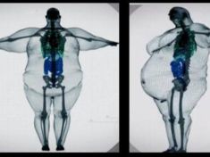 Rentgen, který měl ukázat hrůzu obezity. Ve skutečnosti nikdy nevznikl