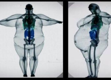 Rentgen, který měl ukázat hrůzu obezity. Ve skutečnosti nikdy nevznikl