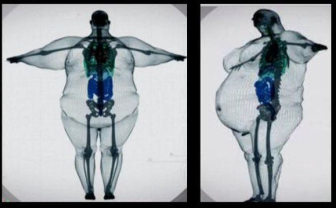 Rentgen, který měl ukázat hrůzu obezity. Ve skutečnosti nikdy nevznikl