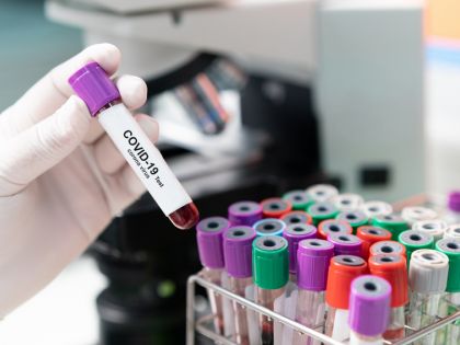 Vídeňští vědci vynalezli jednoduchý test na koronavirus. Ten pozitivní je světle modrý