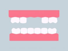 VELKÝ HOLKY: Když zmizí zub