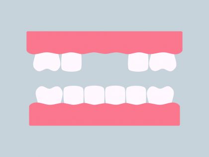 VELKÝ HOLKY: Když zmizí zub